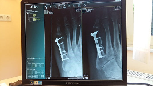 How to identify, treat and prevent a metatarsal stress fracture while running