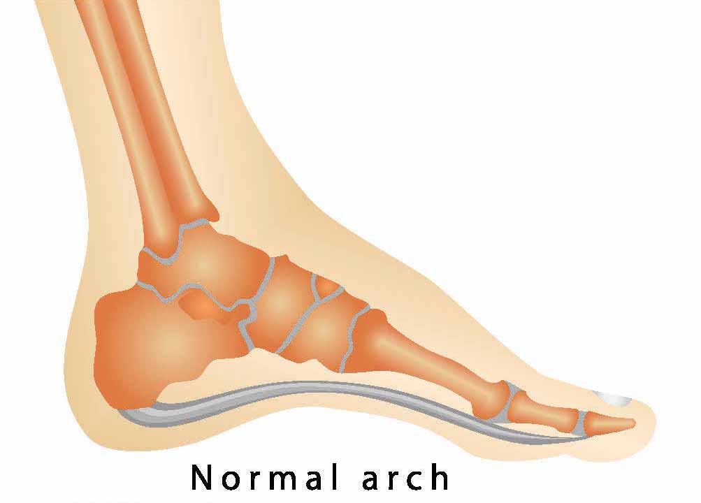 High Arch Example Injury advice High arches | Cause, Treatment and Cure – ENERTOR®